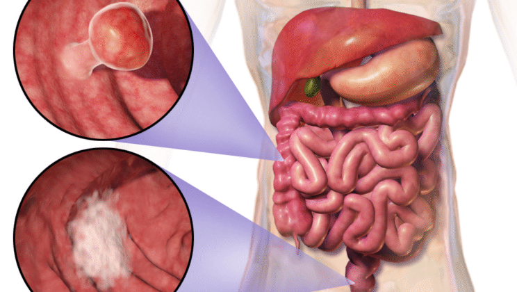 Colorectal Cancer: Causes, Symptoms, Diagnosis, and Treatment