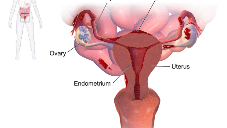 Endometriosis: Causes, Symptoms, Diagnosis, and Treatment