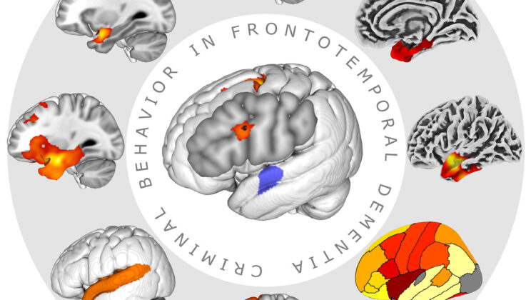 Can You Blame the Brain? The Shocking Link Between Dementia and Criminal Behavior