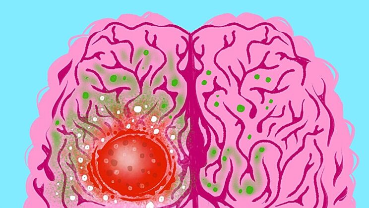 Scientists Discover How Brain Cancer Hijacks Sugar—and a Diet Hack That Could Stop It