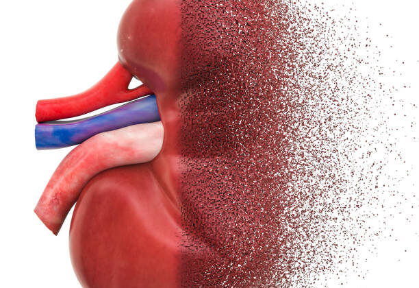 Chronic Kidney Disease: Causes, Symptoms, Diagnosis, and Treatment