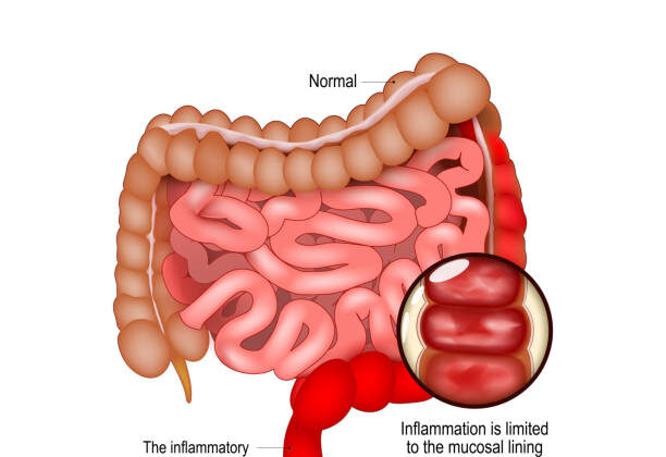 Ulcerative Colitis: Causes, Symptoms, Diagnosis, and Treatment