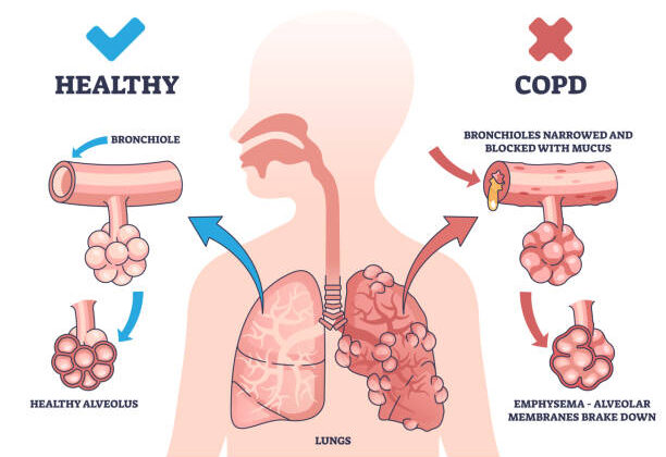 Chronic Obstructive Pulmonary Disease (COPD): Causes, Symptoms, Diagnosis, and Treatment