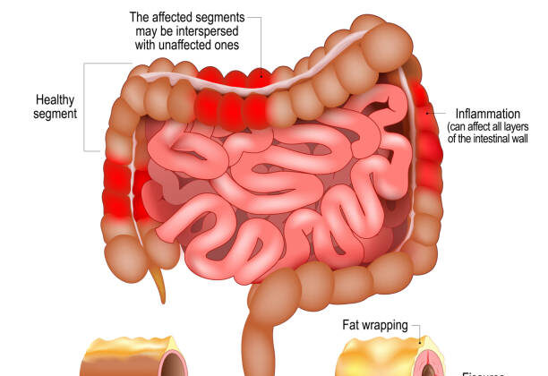 Crohn’s Disease: Causes, Symptoms, Diagnosis, and Treatment