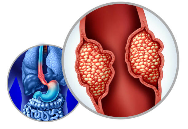 Esophageal Cancer: Causes, Symptoms, Diagnosis, and Treatment