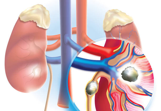 Kidney Stones: Causes, Symptoms, Diagnosis, and Treatment