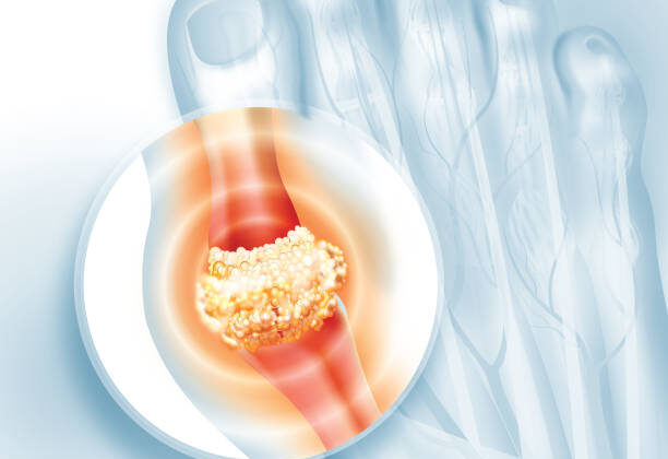 Gout: Causes, Symptoms, Diagnosis, and Treatment