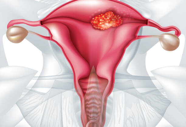 Cervical Cancer: Causes, Symptoms, Diagnosis, and Treatment