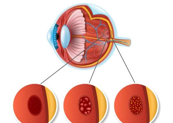 Macular Degeneration: Causes, Symptoms, Diagnosis, and Treatment