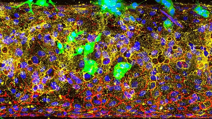 Scientists Crack the Mystery of How Pancreatic Cancer Spreads—And Reveal a Surprising Weakness