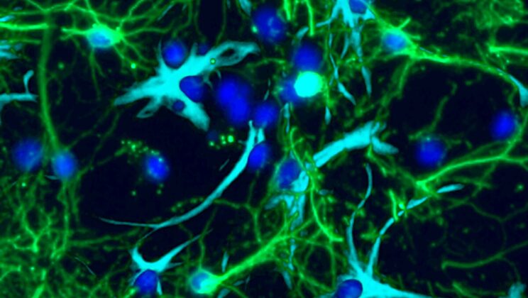 Scientists Discover How a Common Brain Chemical Fuels Childhood Tumors—and How to Stop It