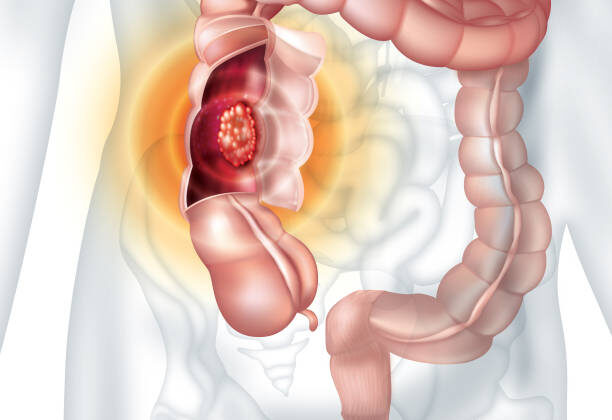 Scientists May Have Finally Defined “Cure” for Colon Cancer — And It’s Sooner Than You Think