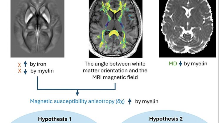 Scientists Discover Hidden Brain Imbalance Behind Schizophrenia — And It’s Not What You Think