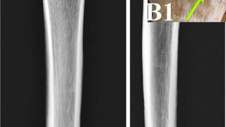 Archaeologists Uncover Ancient Skeleton with Arrow Still Lodged in the Bone—And a Story of Survival