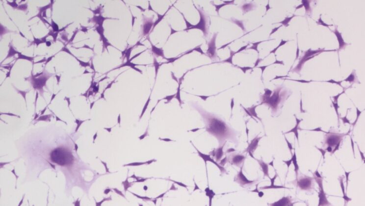 Scientists Finally Crack Hydralazine’s Mystery—and Discover It Stops Aggressive Glioblastoma