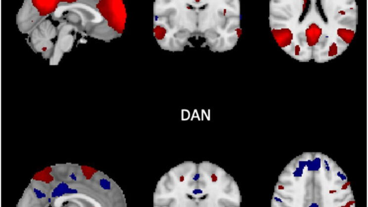 Can Your Brain’s ‘Focus Mode’ Tell You If You Have Alzheimer’s? New Study Says Yes