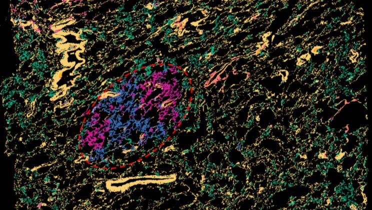 Scientists Map How Lung Cancer Begins—and Discover Inflammation May Be the Spark
