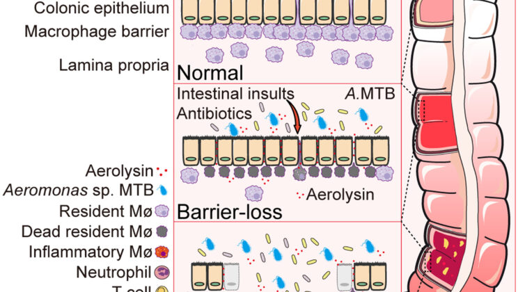 This Bacterial Toxin Could Be the Hidden Cause of Ulcerative Colitis