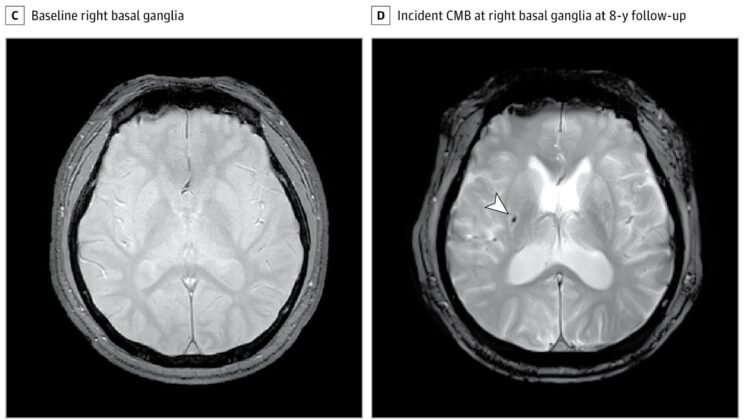 The Silent Nighttime Disorder That May Be Causing Tiny Brain Bleeds, Scientists Warn