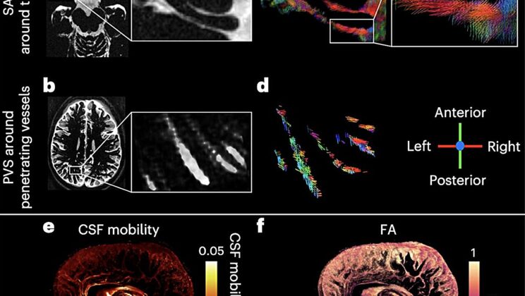 Scientists Uncover the Secrets of Brain Fluid to Unravel Alzheimer’s and Neurodegenerative Diseases
