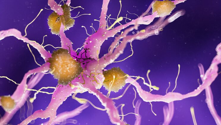 The Connection Between Chronic Sleep Loss and Alzheimer’s Disease