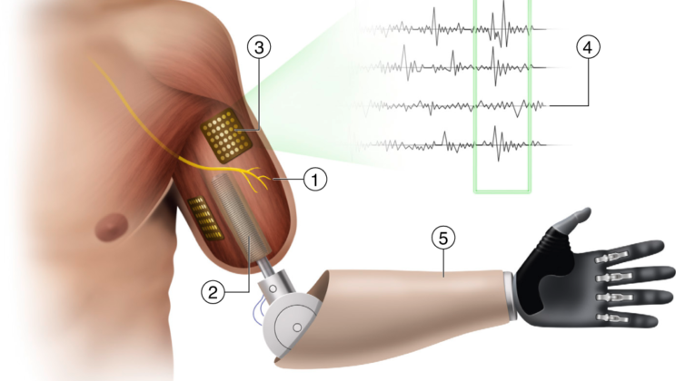 Bionic Limbs: When Prosthetics Outperform Natural Anatomy