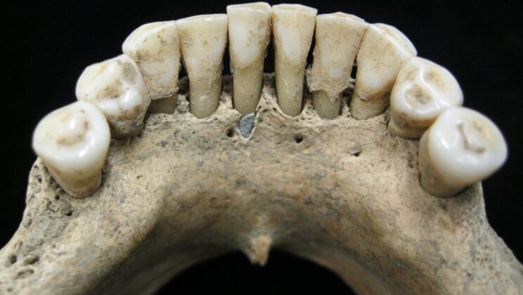 10 Things Your Teeth Reveal to Archaeologists