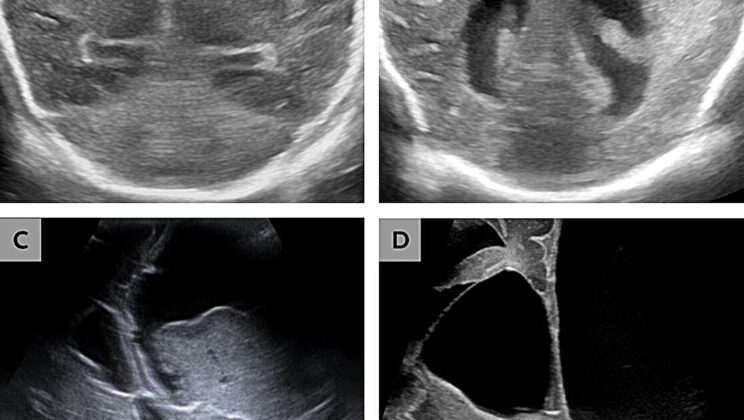 Doctors Warn of a Hidden Pathogen Turning Infant Brain Tissue to Liquid
