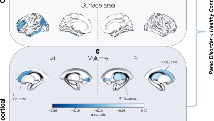 Scientists Scanned 5,000 Brains to Finally Uncover the Physical Imprint of Panic