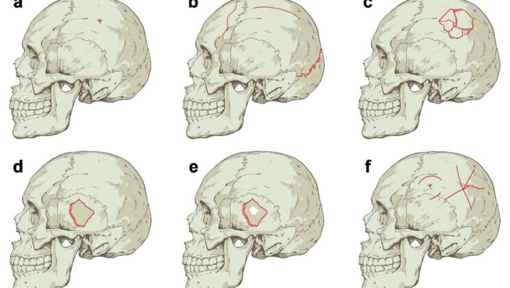 New Forensic Tools Are Decoding the Violent Secrets Hidden in 3000 Year Old Bones