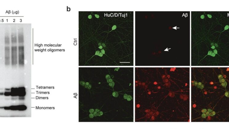 Alzheimer’s Disease Might Actually Start in Your Gut Years Before Memory Fades