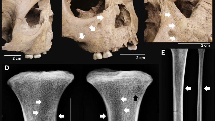 Ancient Teeth in Vietnam Just Shattered a Massive Medical Myth