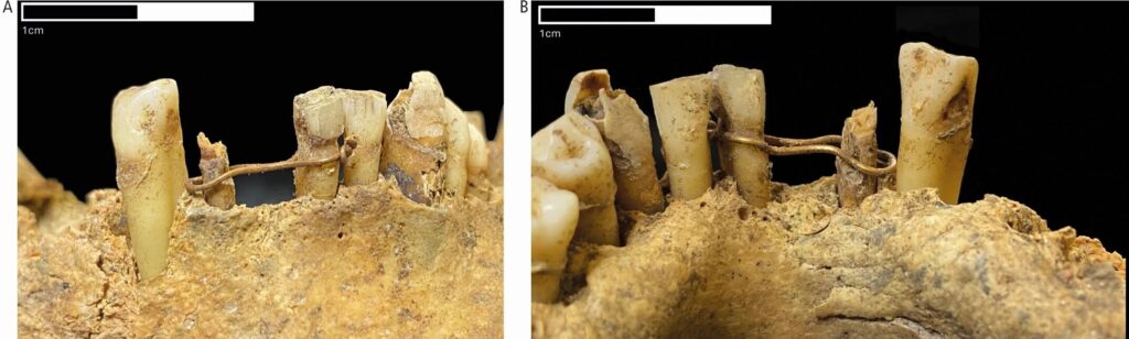 Scotlands Oldest Dental Bridge Found on Medieval Mans Jaw Was Made of 20-Carat Gold