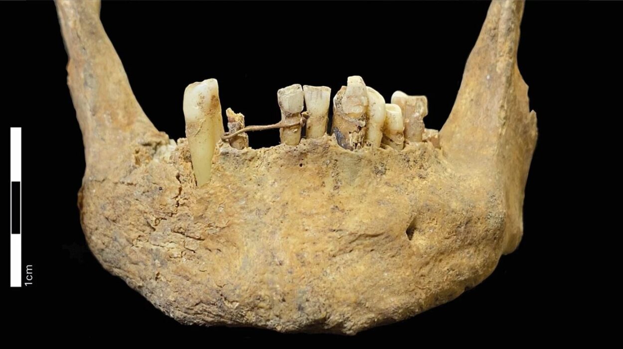 Scotlands Oldest Dental Bridge Found on Medieval Mans Jaw Was Made of 20-Carat Gold