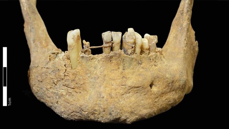 Scotland’s Oldest Dental Bridge Found on Medieval Man’s Jaw Was Made of 20-Carat Gold