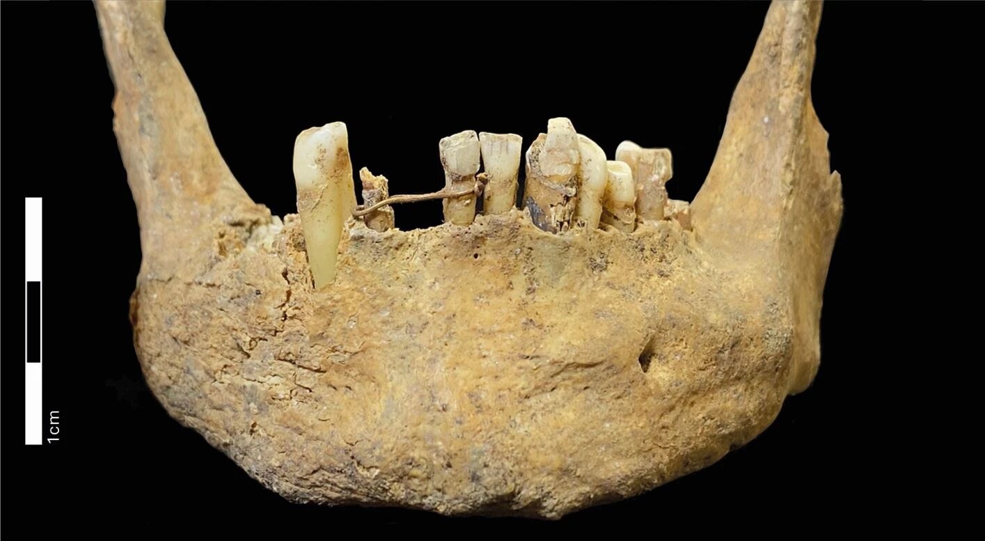 Scotlands Oldest Dental Bridge Found on Medieval Mans Jaw Was Made of 20-Carat Gold
