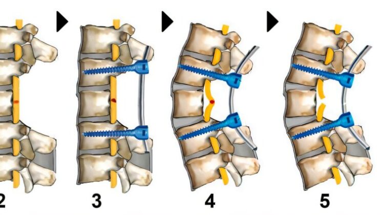 Experimental Gel Helped Completely Paralyzed Pigs Walk Again After Fully Severed Spinal Cords by Reconnecting Damaged Nerve Fibers