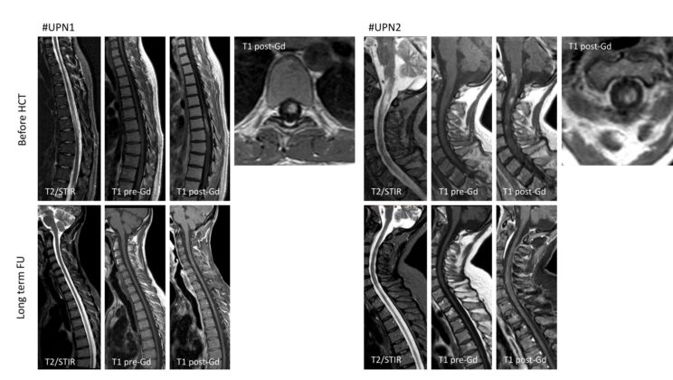 Donor Stem Cell Transplants Kept Two Patients With Severe Neuromyelitis Optica Free of Relapses for More Than 15 Years Without Ongoing Treatment