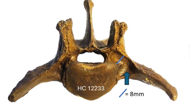 Discovery of Enlarged Spinal Openings in Three Extinct Smilodon Fossils Suggests Rare Neurological Tumors Affected Ice Age Predators Near the End of the Pleistocene