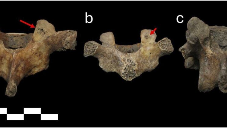 Children as young as 4 developed spinal damage from hard labor centuries ago